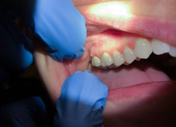 Best Emergency Treatment for Oral Infections in Elizabeth, PA